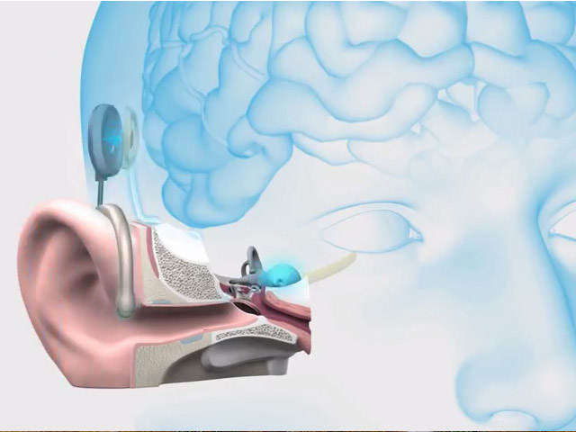 Schematic diagram of the cochlear implant